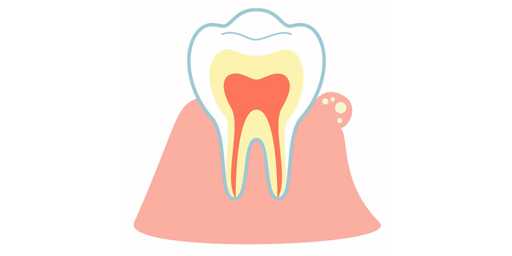 歯茎にできもの（フィステル）ができる原因