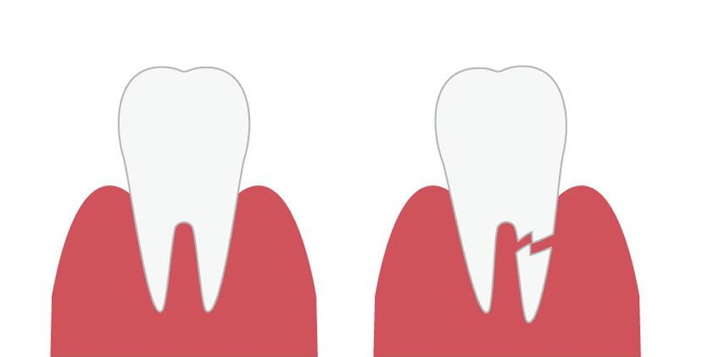 歯を失う可能性の高い歯根破折の症状と原因