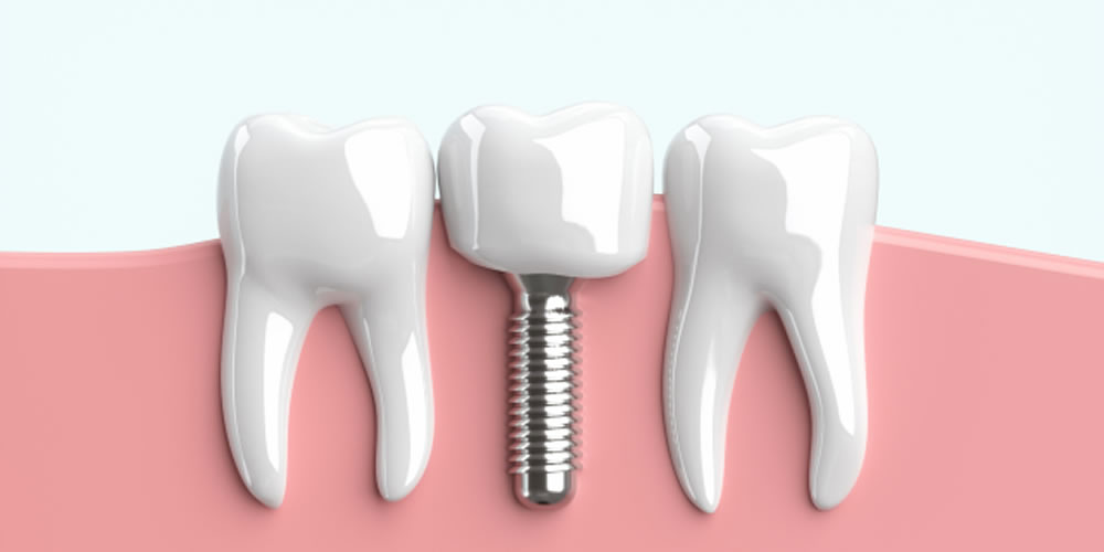 インプラントと天然歯の違いについて