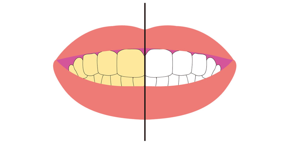 歯が黄ばむ原因について